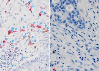 Lokales C3 beeinflusst Erfolg der Krebsimmuntherapie
