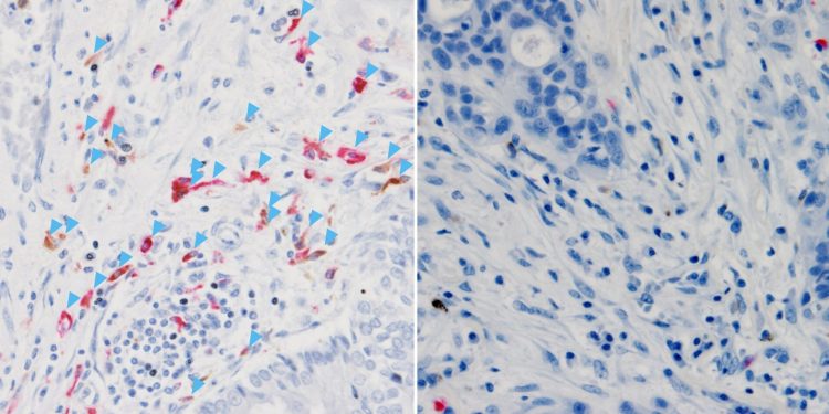 Lokales C3 beeinflusst Erfolg der Krebsimmuntherapie
